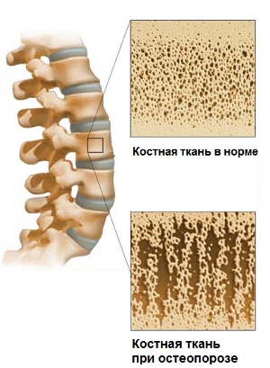 Нормальное состояние и кость при остеопорозе