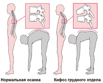 Нормальная осанка и осанка при кифозе грудного отдела позвоночника